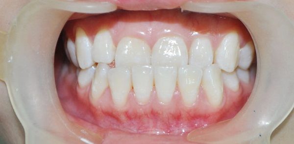 Niềng răng không mắc cài: Giải pháp chỉnh nha thẩm mỹ hiện đại